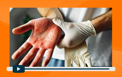 sesion-2-alergia-al-latex-el-enemigo-silencioso-del-personal-de-salud