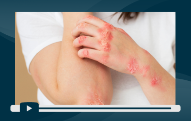 sesion-5-piel-en-alerta-dermatitis-ocupacional-por-desinfectantes-hospitalarios-portada