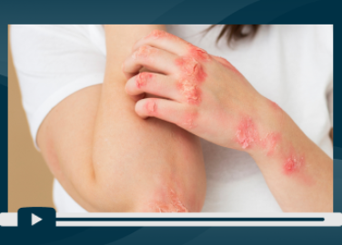 sesion-5-piel-en-alerta-dermatitis-ocupacional-por-desinfectantes-hospitalarios-portada